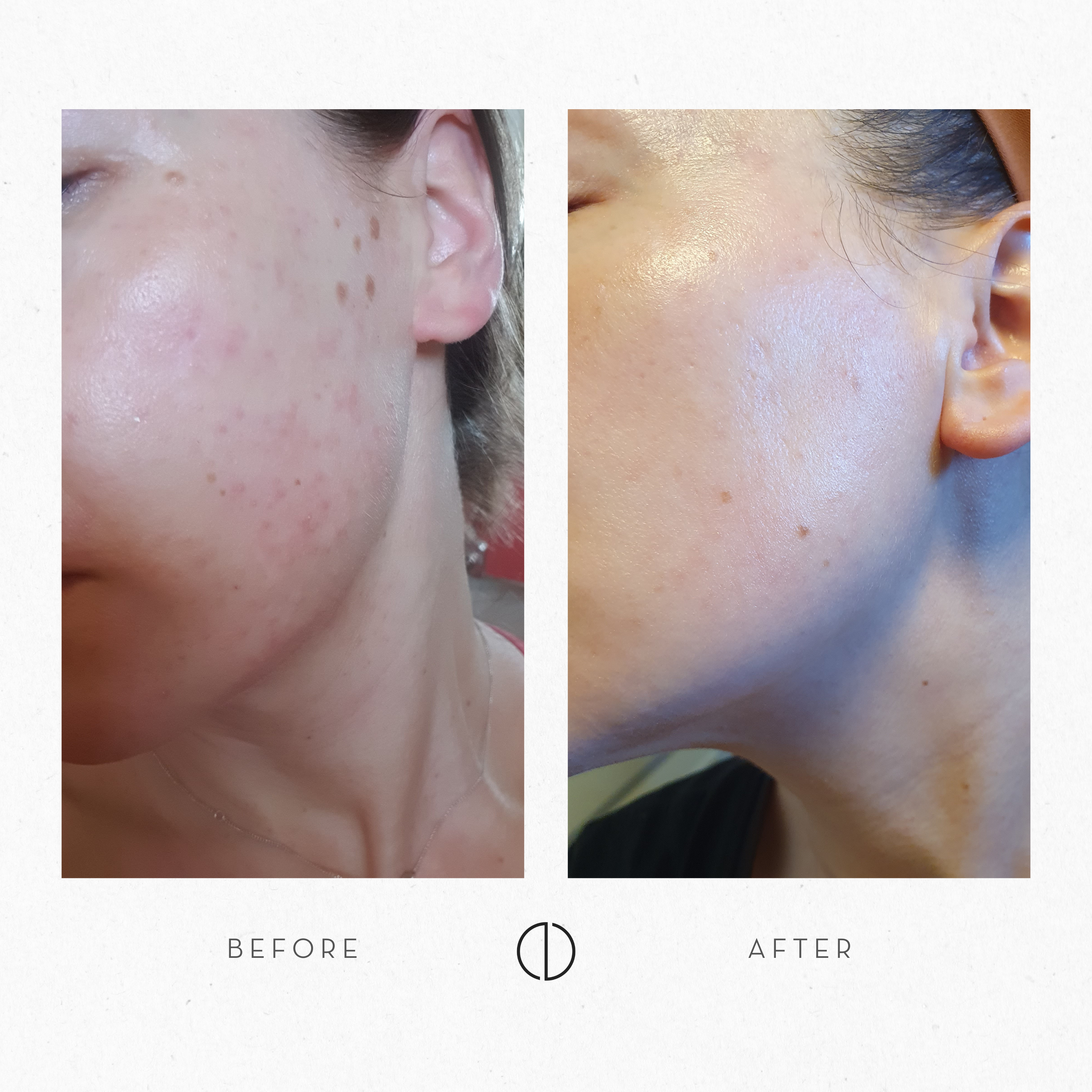 Anna and sensitised and irritated skin