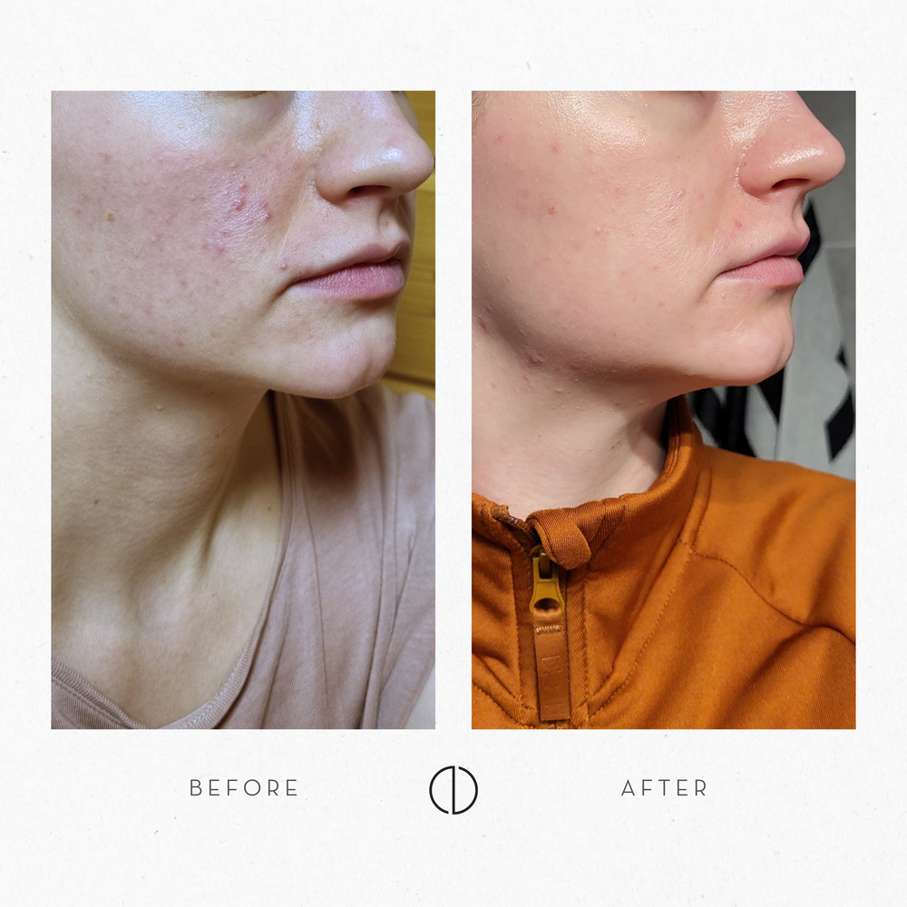 Jenna & Problem Skin (POD, seborrhea & rosacea)