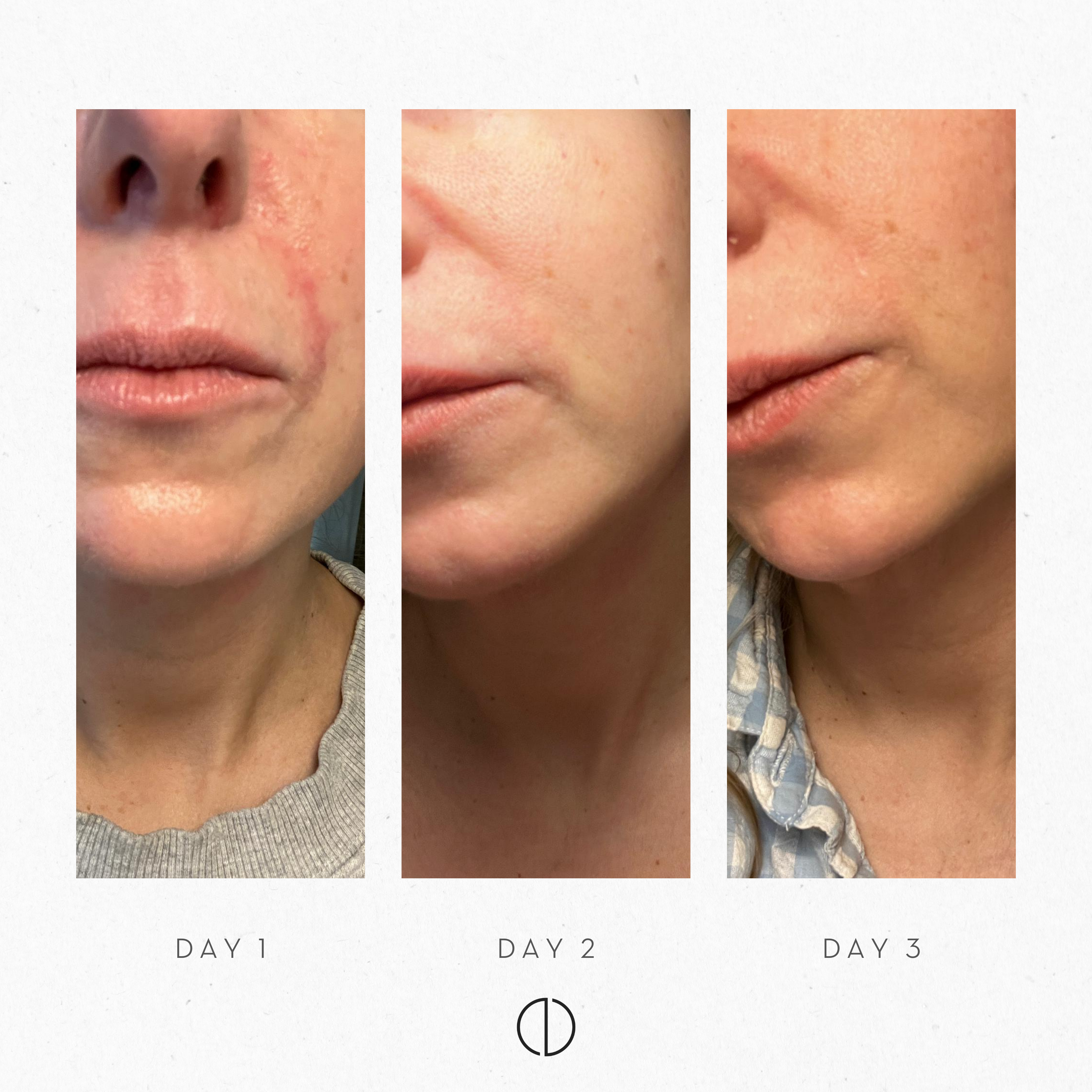 Johanna: POD on atopic skin