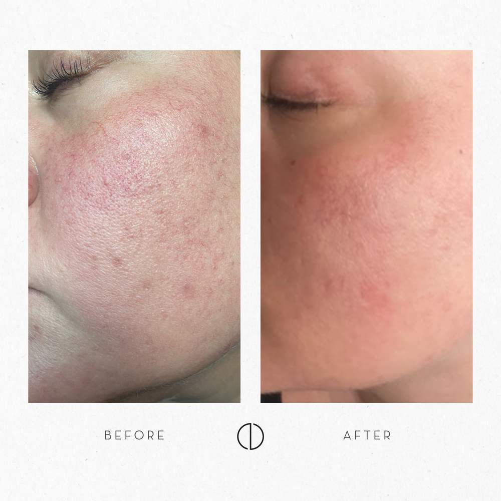 Kaisa & atopic, acne-prone skin