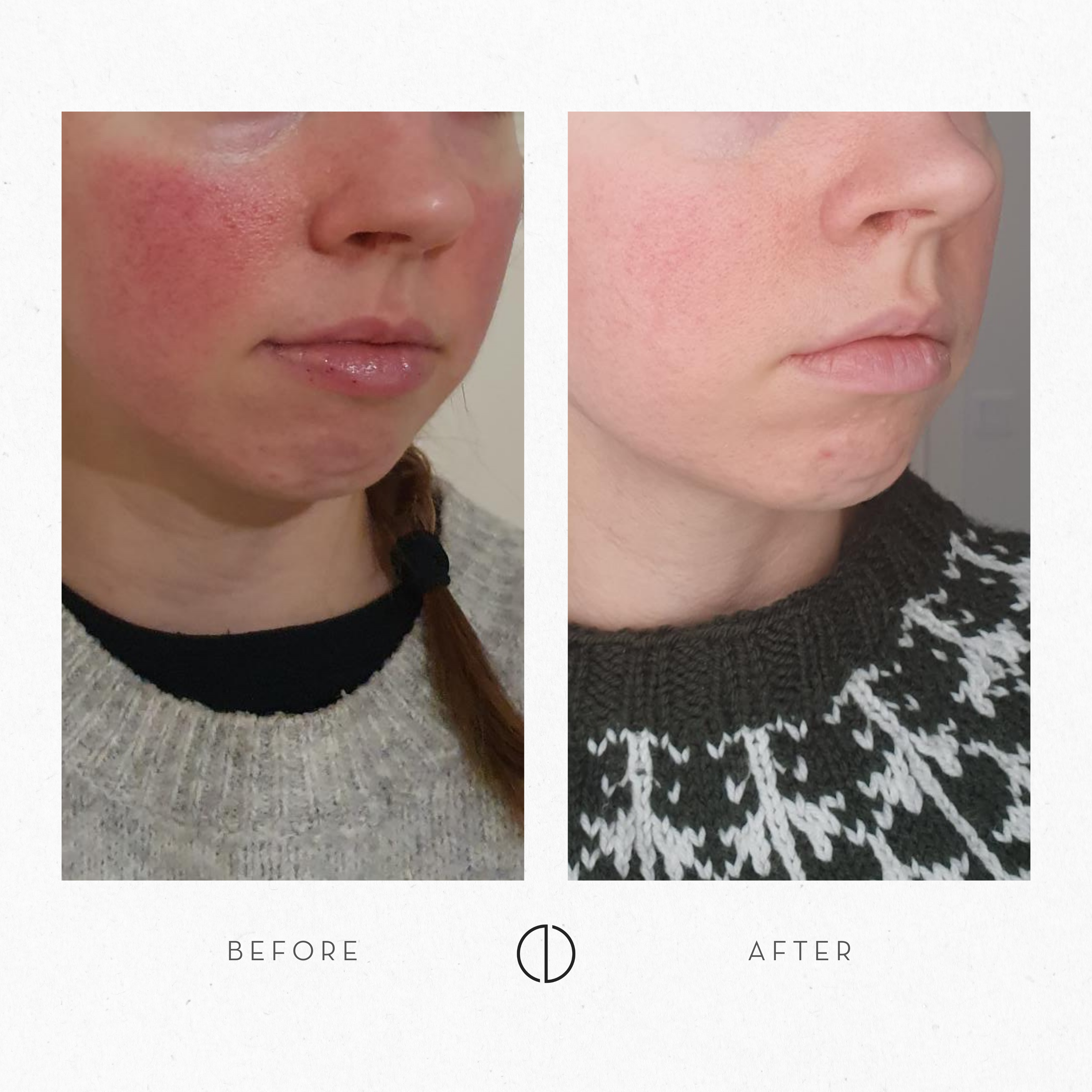 Krista: Rosacea