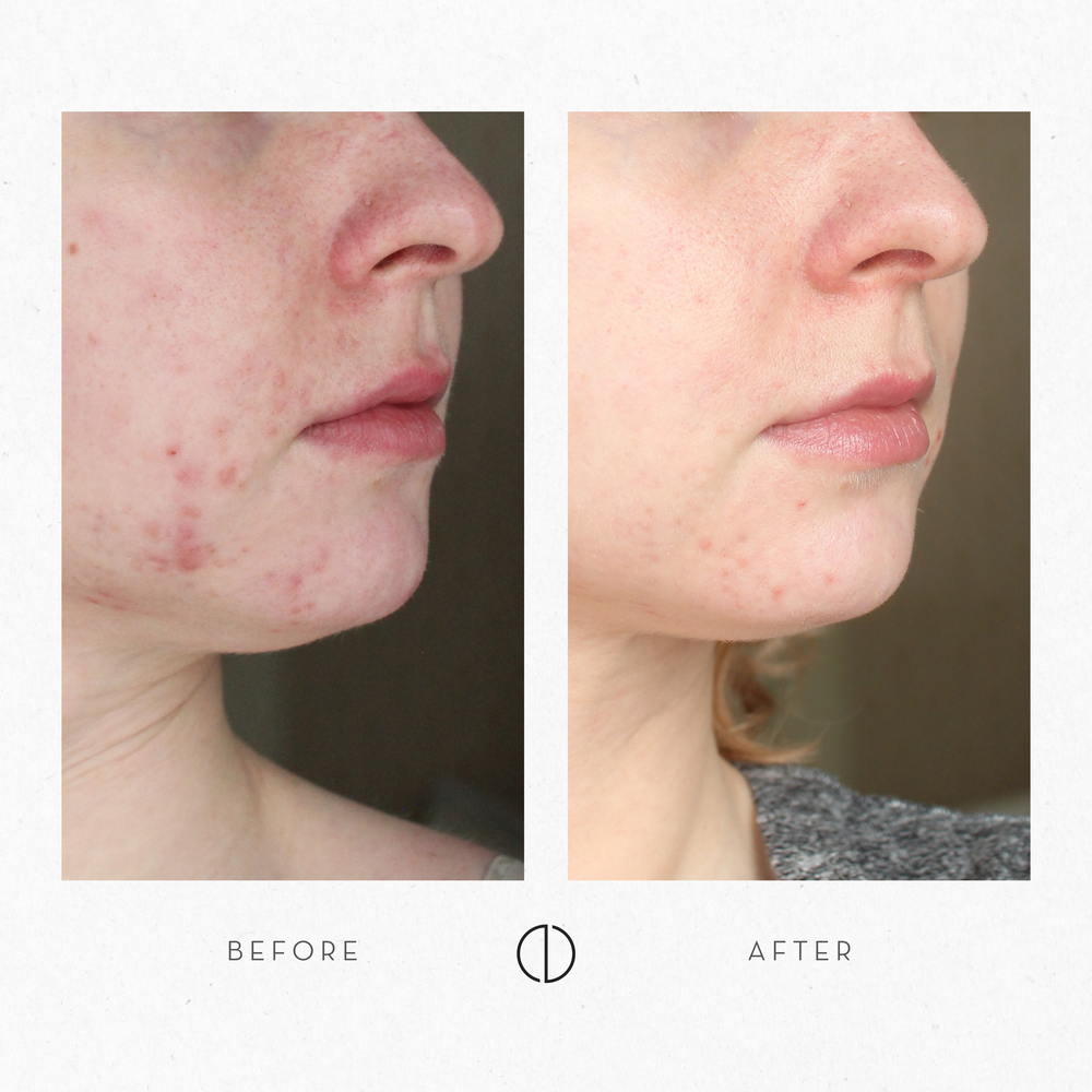 Milja & Sensitive, breakout-prone skin