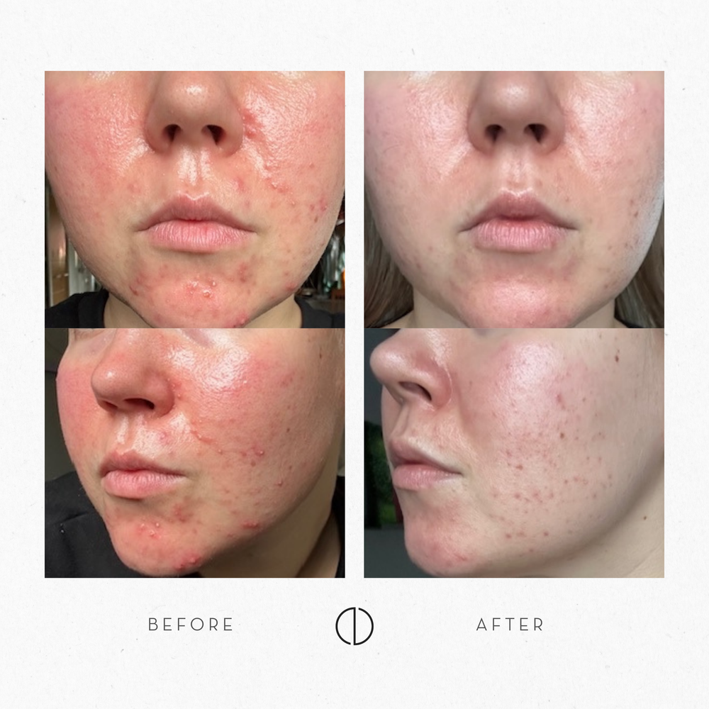 Elsa & problem skin with POD, hormonal acne & rosacea