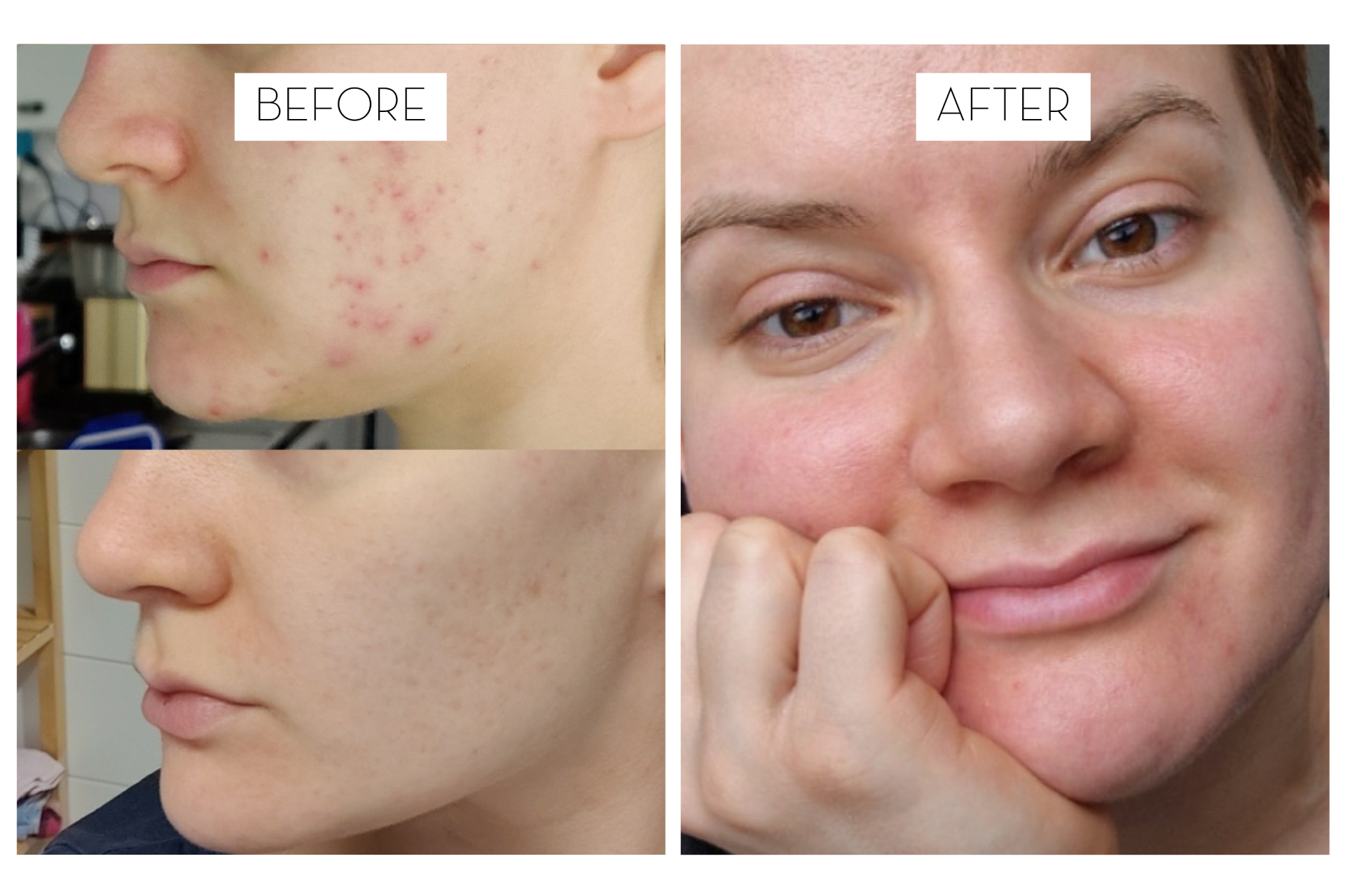 How to choose skincare for acne-prone skin