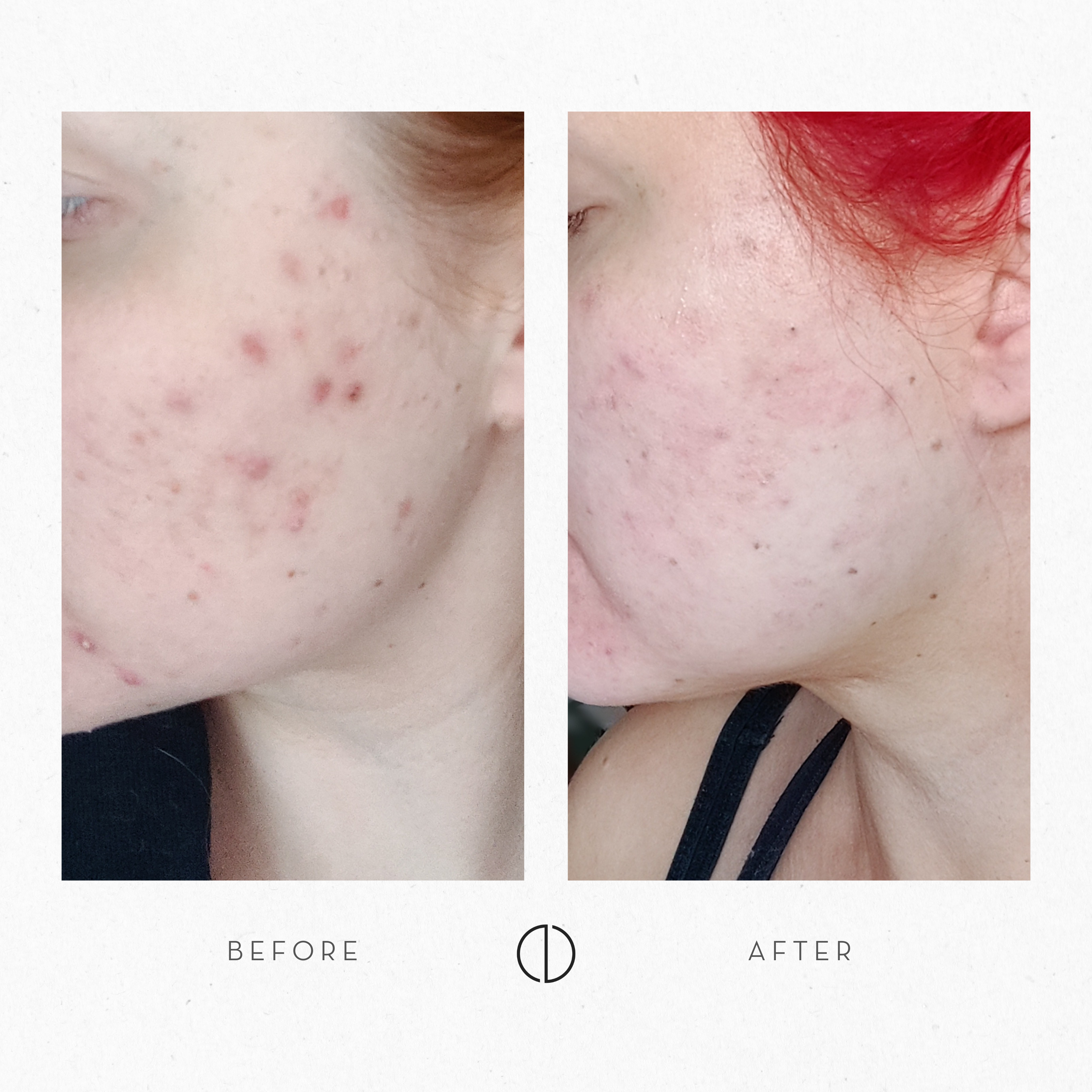 Iida-Maria & dry skin and adult acne