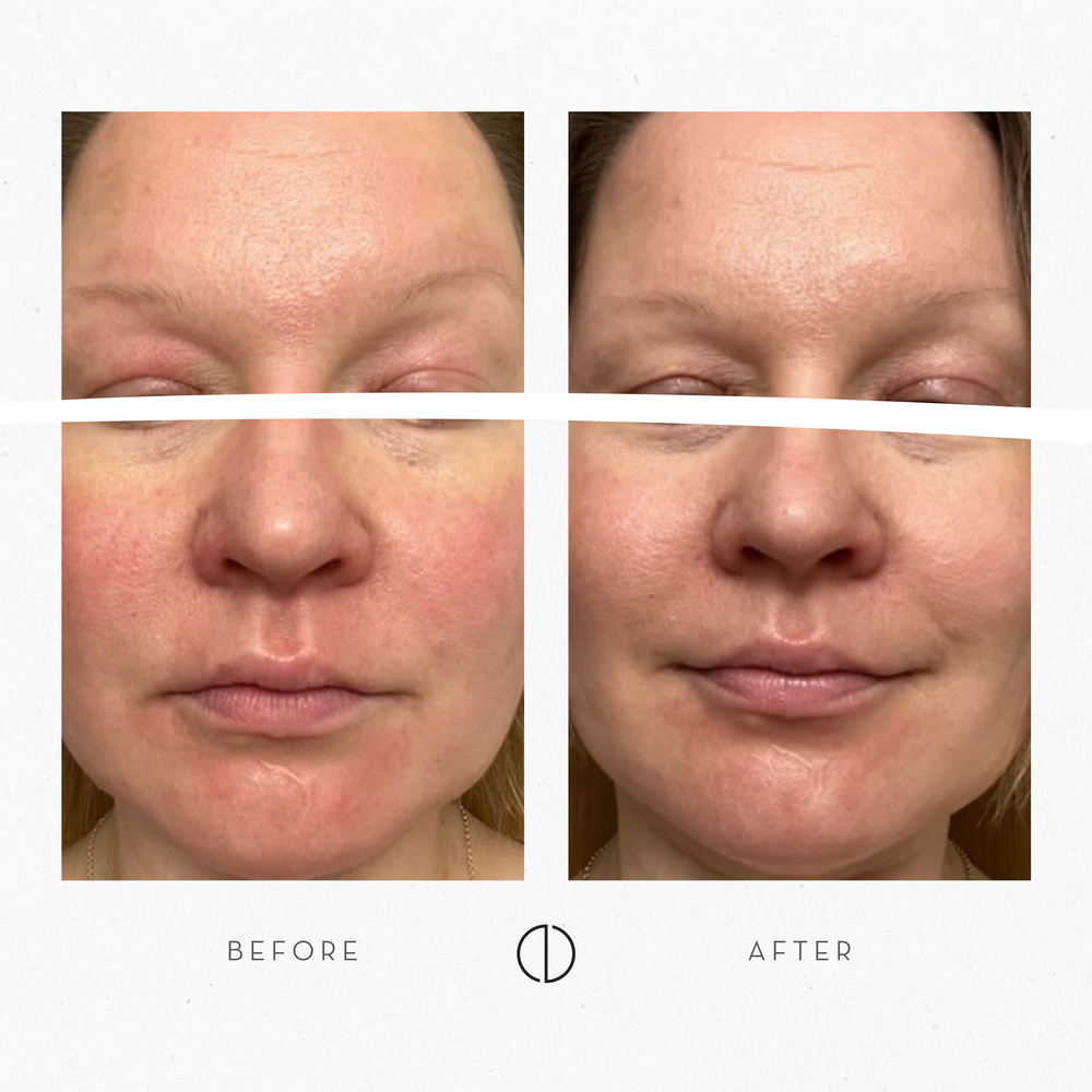 Marjut & Atopic skin