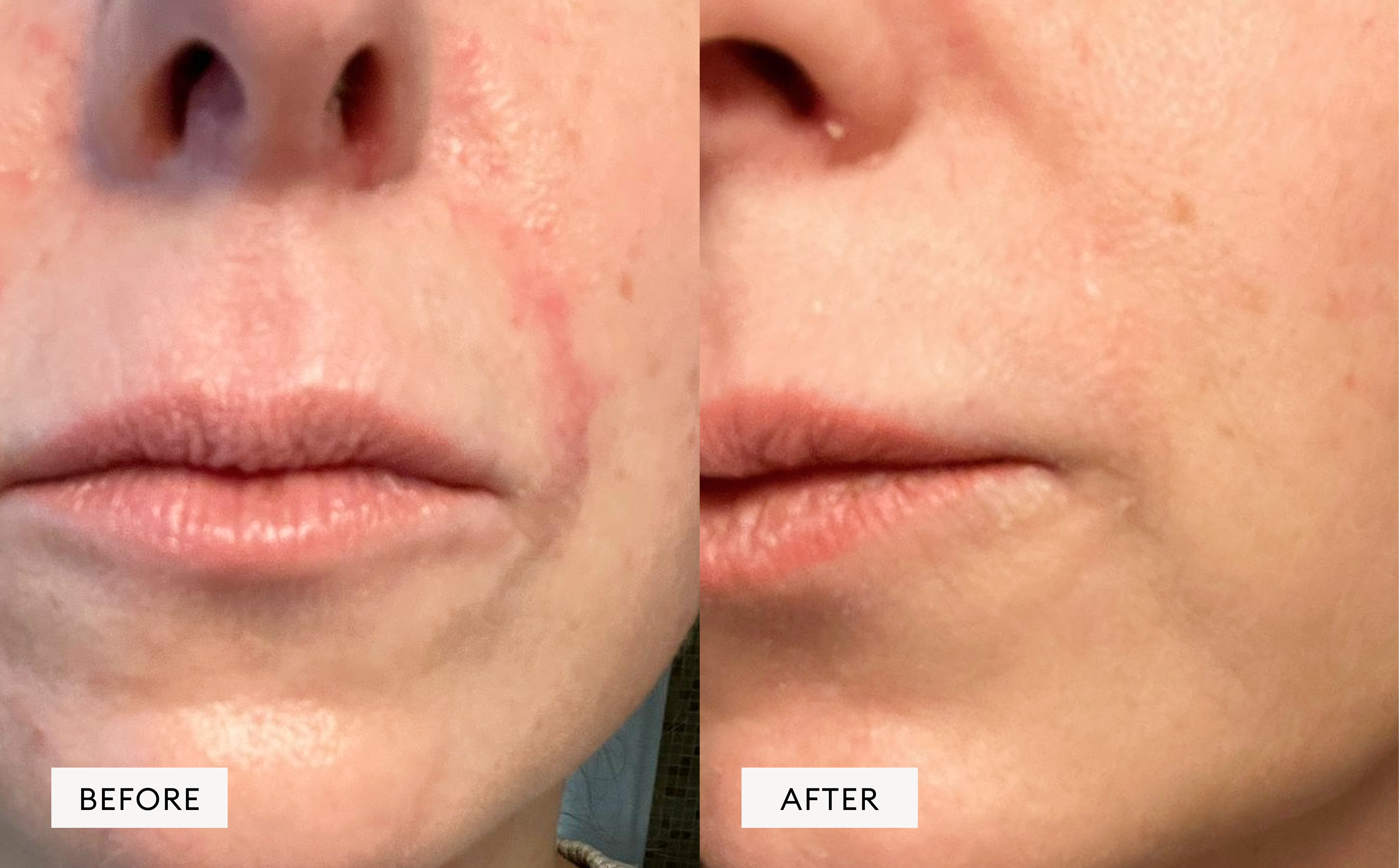 Perioral Dermatitis POD