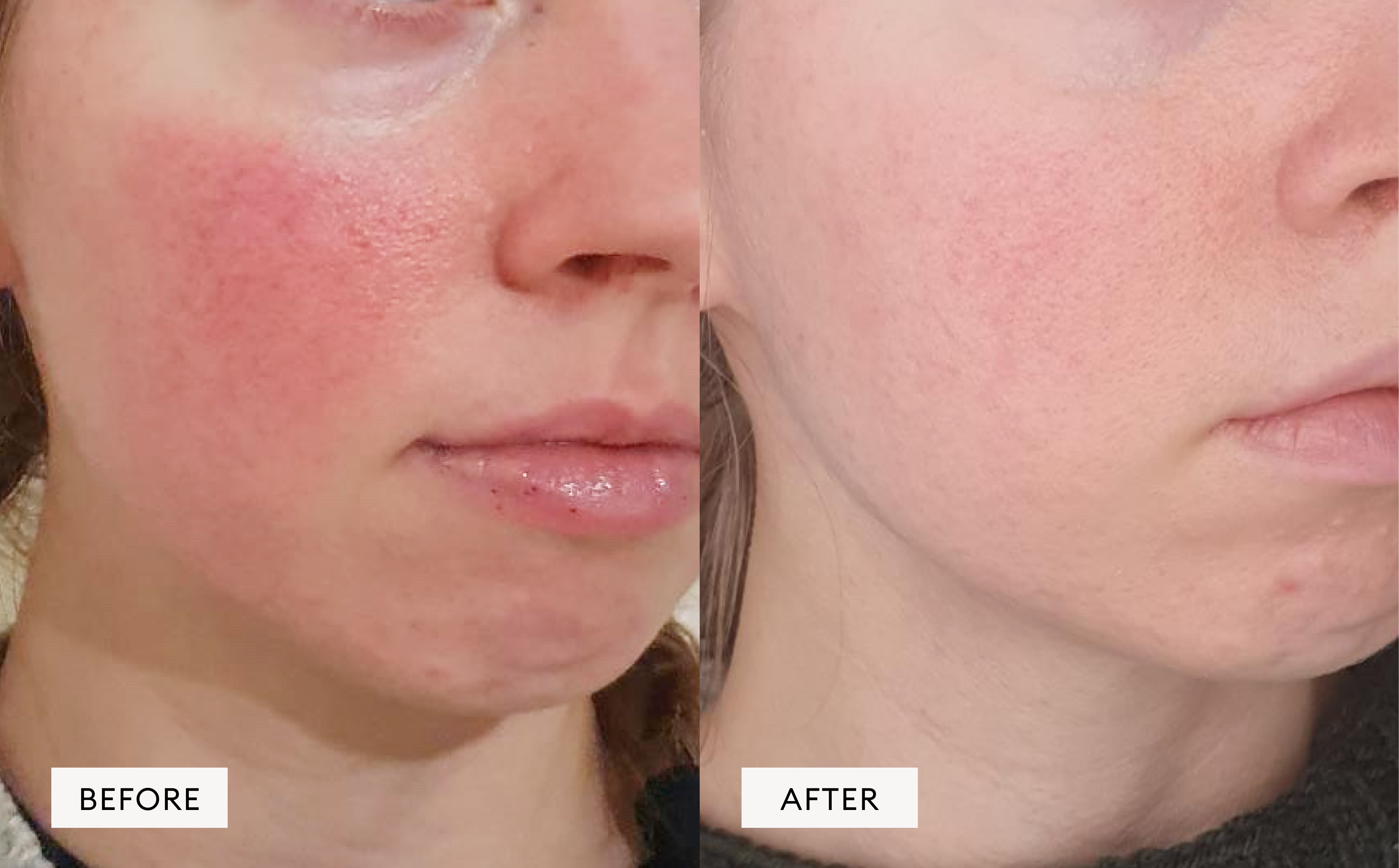 Rosacea
