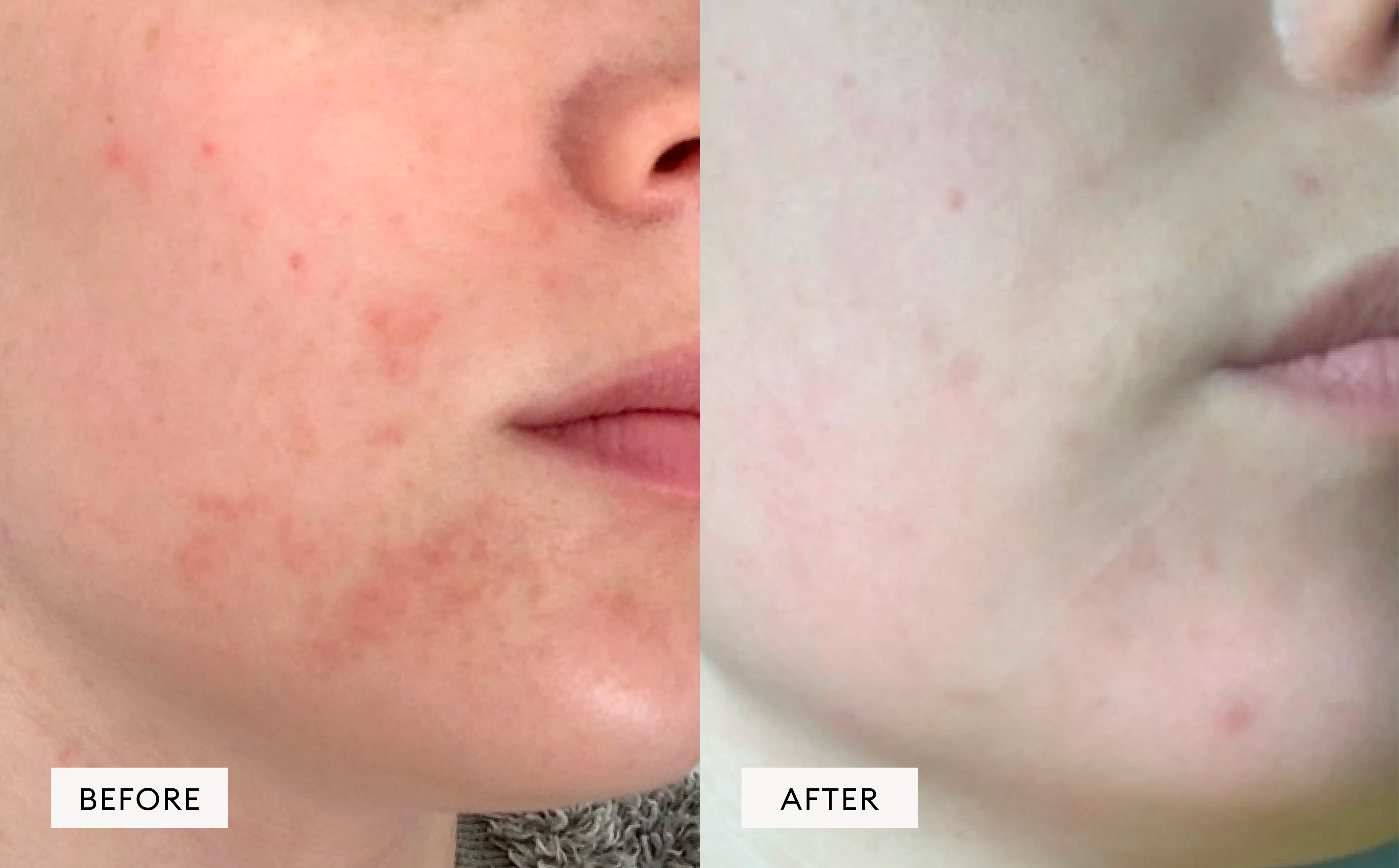 Irritated skin & redness