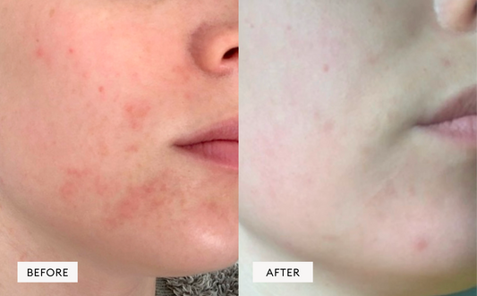 Irritated skin & redness